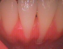 歯肉が退縮した切歯